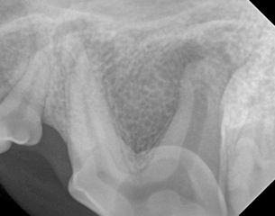 Peri-apical bone loss in the left maxillary premolar tooth